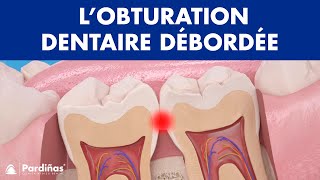 Problèmes de plombage dent – L’obturation dentaire débordée © [upl. by Dearden]