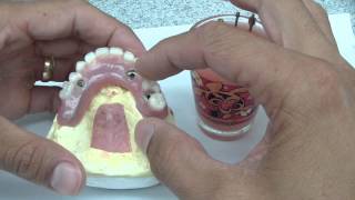 Overdenture Abutment Part 1 [upl. by Kcirdnekel]