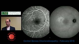 Central Serous Chorioretinopathy [upl. by Perdita]