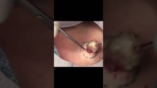 Open Wide Dr Pimple Popper POPS amp Pulls MASSIVE… shorts [upl. by Lechar397]