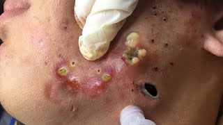 Big Cystic Acne Blackheads Extraction Blackheads amp Milia Whiteheads Removal Pimple Popping  6764 [upl. by Ashford994]