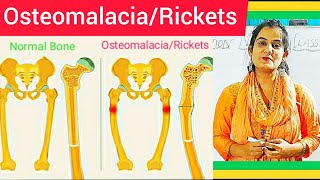 Osteomalacia amp Rickets  Cause Symptom Treatment Diagnosis MedicalSurgical amp Nursing Management [upl. by Hedberg]