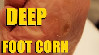 Deep Foot Corn Removal after 50 years [upl. by Qifahs]