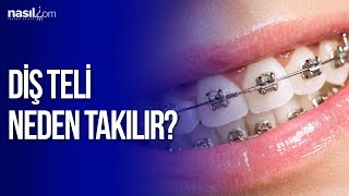 Diş teli neden takılır  Sağlık  Nasilcom [upl. by Lebasi679]