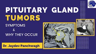 Pituitary Gland Tumour Symptoms Dr Jaydev Panchwagh Neurosurgeon Pune [upl. by Rusert]