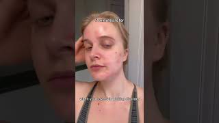 Picking your skin uncontrollably That has a name dermatillomania acne skincaretips explorepage [upl. by Iinden995]