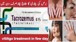 Tacrozemus ointment  eczema Causes amp Treatment  How to get rid of Eczema  vitiligo Skin Care [upl. by Malan]