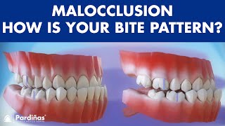 Malocclusion  Bite patterns © [upl. by Ssalguod]