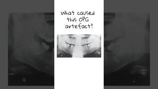 What caused this OPG artefact dentist dentalstudent dentistry dentistryknowledge nbde [upl. by Aicxela]