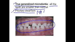 Microdontia [upl. by Eleon]