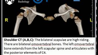 Sprengel Deformity [upl. by Sitarski]