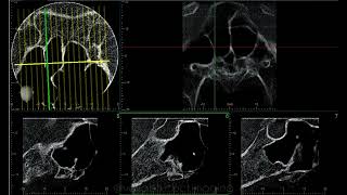 SPHENOID SINUS CASE REPORT [upl. by Friedberg]