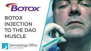 The DAO Muscle  BOTOX® Injections in Dallas [upl. by Nnairak637]