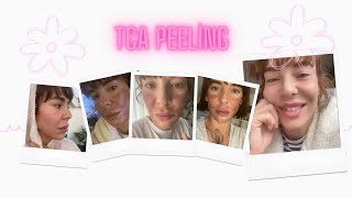 TCA peeling ile yüzümü soydum  Kimyasal peeling [upl. by Yerggoeg]