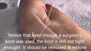 How to Put in Simple Interrupted Sutures Using a Curved Needle and the Rule of Halves [upl. by Viridi]