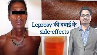 Leprosy की दवाइयों के sideeffects  Dapsone  Clofazimine  Rifampicin  Hansens disease leprosy [upl. by Herriott]