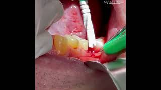 Placement of a zsystems zirconia bone level implant by Dr Sarkissian [upl. by Adnal]