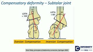 Compensatory theory of osteotomies around kneeEffect on Hip amp FampA alternate ways  H Sharma [upl. by Jadd]