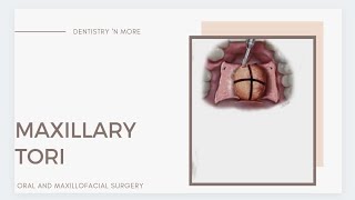 MAXILLARY TORI  MANDIBULAR TORI  PRE PROSTHETIC SURGERY [upl. by Clarissa]