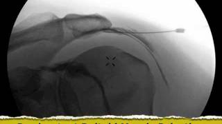 Inadvertent Deltoid Muscle Injection under Fluoroscopy  ThePainSourcecom [upl. by Vanda]