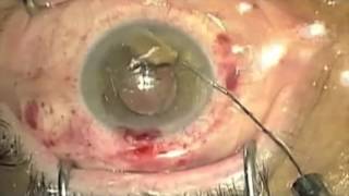 Miotic small pupil after laser cataract surgery [upl. by Ion701]