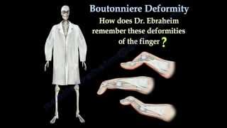 Boutonniere Deformity  Everything You Need To Know  Dr Nabil Ebraheim [upl. by Rengia]