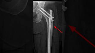 Atypical femoral fracture and ORIF xrays [upl. by Aticilef236]