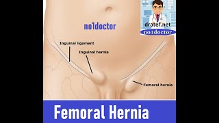 Femoral HerniaFemoral Canal Anatomy Groin HerniaInguinal Hernia SurgeryLap Hernia surgery [upl. by Marchelle]