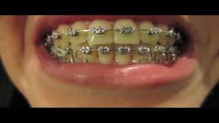 Braces Update  15 One molar elastic [upl. by Mcclain]