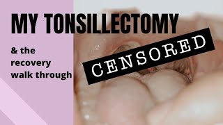 MY TONSILLECTOMY Daybyday recovery walkthrough [upl. by Nwahsuq]