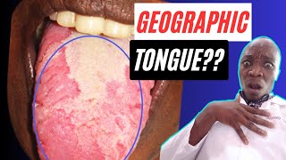 What is a Geographic Tongue  Benign Migratory Glossitis Treatment for a Geographic Tongue [upl. by Conlan]