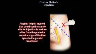 Glute injection buttock injection [upl. by Avlis]