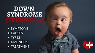 What is Down Syndrome Trisomy 21 Down syndrome Trisomy 21 Made Easy [upl. by Eifos]