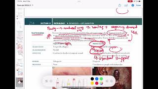 Scar Formation  hypertrophic vs keloid  Pathology 34  First Aid USMLE Step 1 in UrduHindi [upl. by Kate]