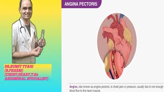 CHRONIC ANGINA PACTOTARIS [upl. by Sugna]