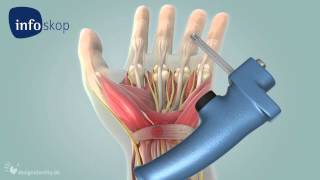 3D medical animation  Arthroscopy  Carpal Tunnel Syndrome CTS [upl. by Esteban]