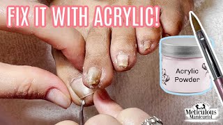 How to use Acrylic to Fix a Pincer Toenail Tutorial [upl. by Eimmis]