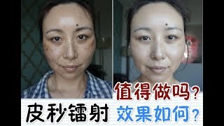 PicoSure Laser Review  BeforeampAfter皮秒镭射体验＋前后对比MsLindaY [upl. by Zigmund]