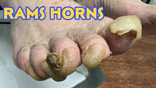 RAMS HORNS NAILS ON MULTIPLE TOES [upl. by Aihsenot958]