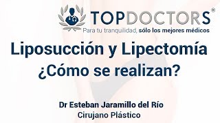 Liposucción y Lipectomía Técnicas para mejorar el contorno abdominal [upl. by Coussoule]