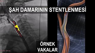 Şah Damarındaki Karotis Darlığın Stent ile Ameliyatsız Açılması Örnek Vakalar [upl. by Rumpf]