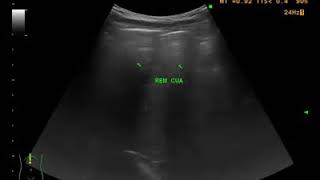 PNEUMOPERITONEUM tạm dịch  tràn khí phúc mạc  Bs Đăng Hùng [upl. by Ushijima138]