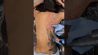 Tattoo Removal😱 [upl. by Carthy]