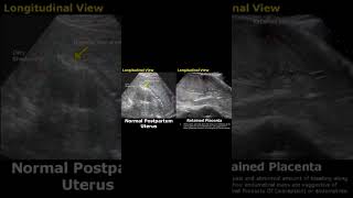 post partum uterus [upl. by Nysila]