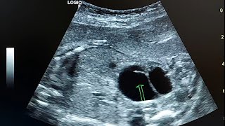 ultrasound case  Anhydramnios due to fetal renal tract anomaly [upl. by Hakvir]