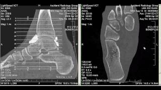 CT Arthrogram of my Ankle 2 April 2009 [upl. by Nilrem303]