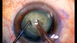 Phaco Chop Mastery Horizontal and Vertical for Safe Cataract Surgery [upl. by Callery]