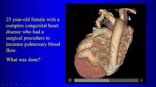 21 Surgery for Congenital Heart Disease [upl. by Aroled]