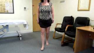 Patient walking 5 months after High Tibial Osteotomy HTO Surgery [upl. by Annelg]