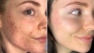 How I Cleared my Acne Scars at Home [upl. by Ross864]